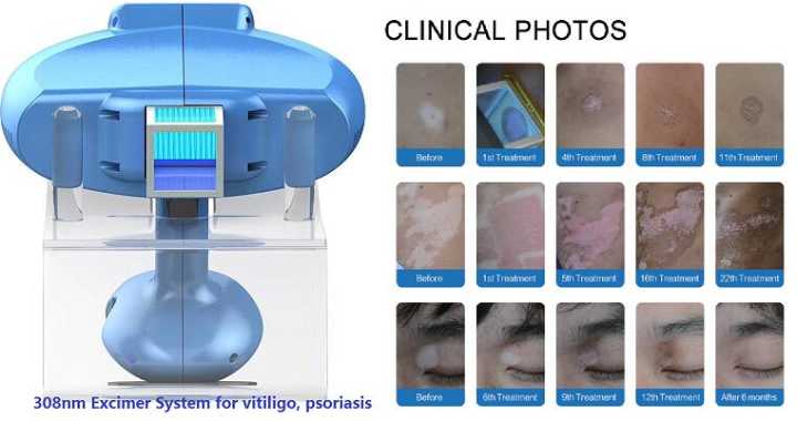 HOT SALE Vitiligo treatment 308nm portable light therapy machine 308nm