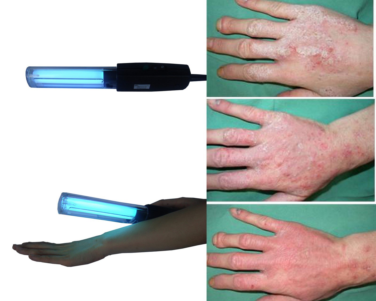 311nm house use Handhold uv lamp for vitiligo