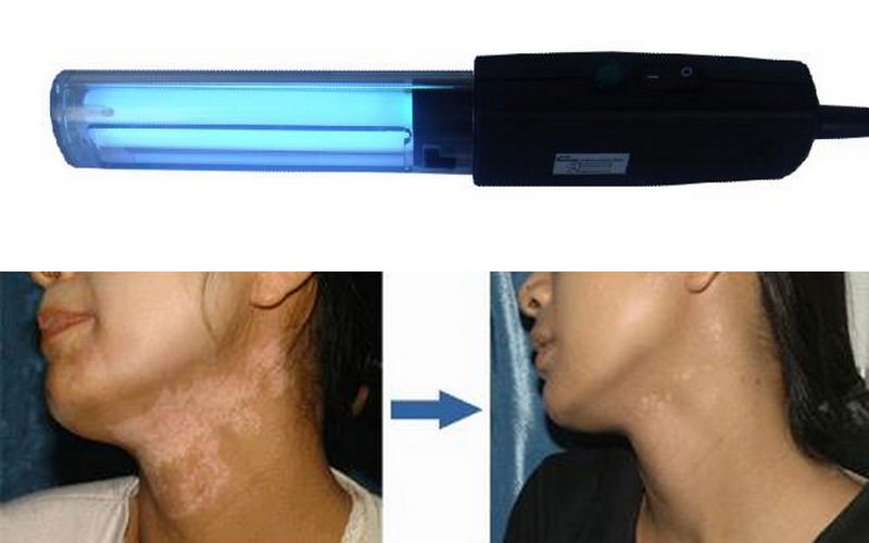 311nm UVB lamps for Vitiligo, Psoriasis, Eczema, Atopic Dermatitis