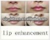 cross_polymer_hyaluronate_restylane_dermal_filler_for.summ.jpg